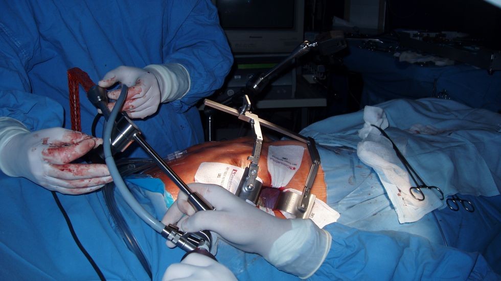 Małoinwazyjna operacja naprawy zastawki mitralnej serca